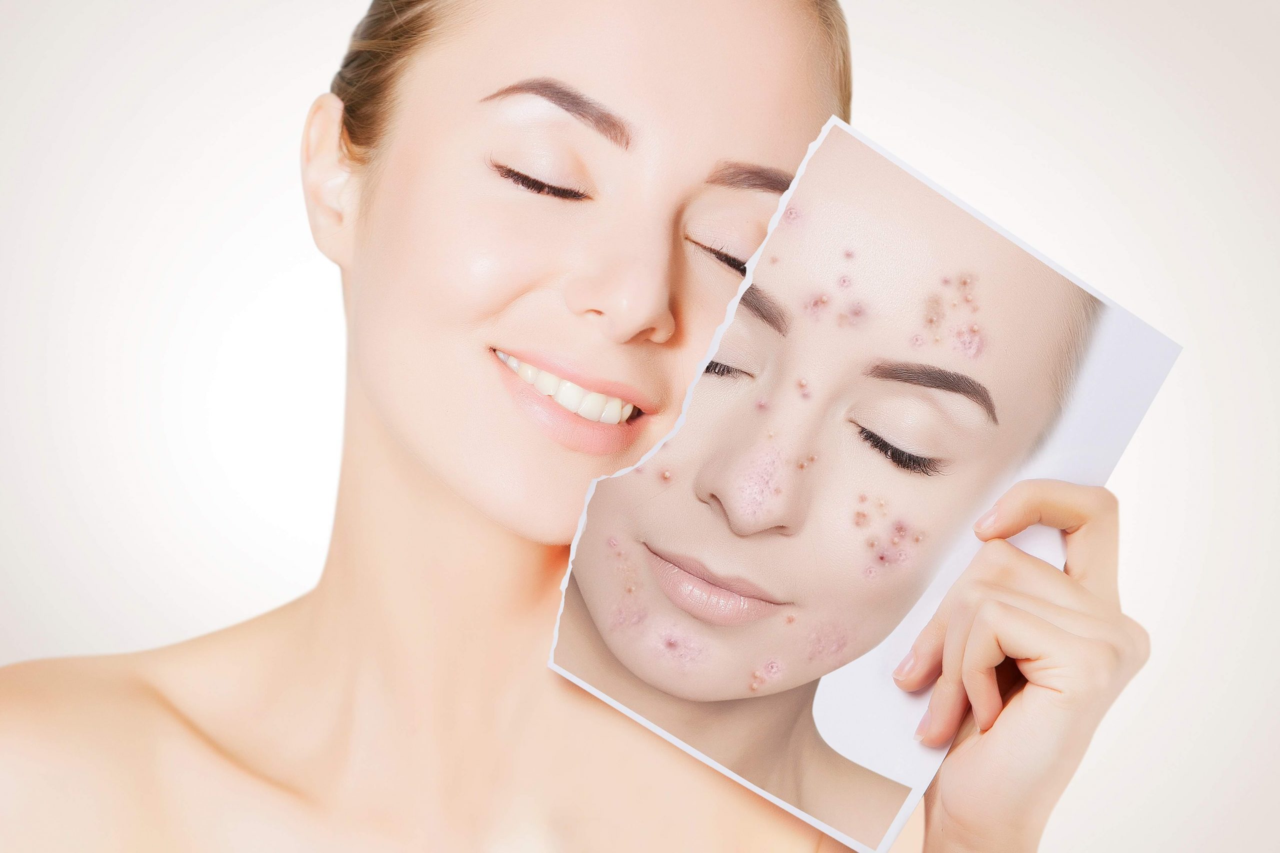 Acne - Tratatmento do rosto - Santock